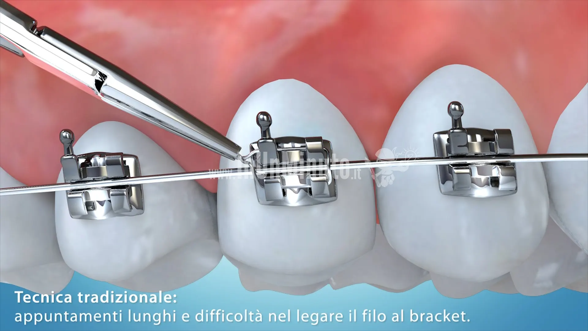 impianto dentale realizzato in 3D con bracket applicati