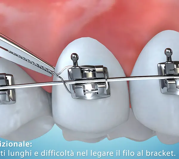 Animazioni-3D-bracket-dentali