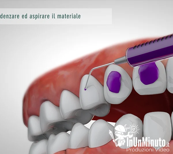 impianto-dentale-posizionamento-attachments